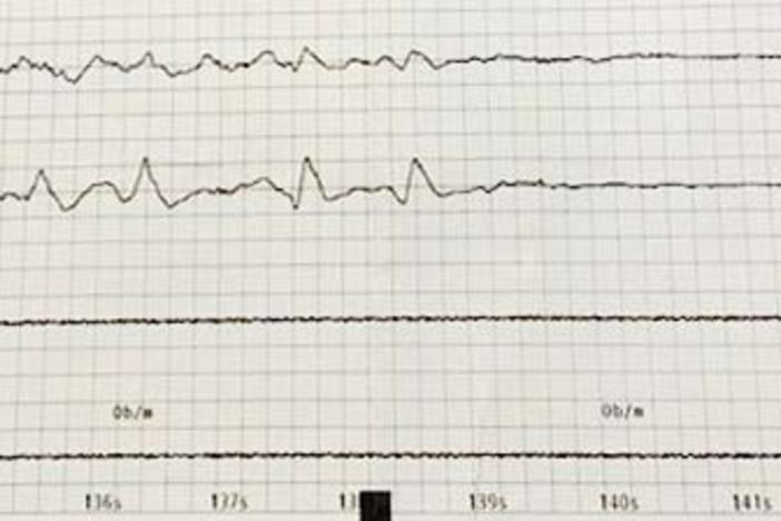 Brain activity from an unnamed ECT patient is recorded and printed out onto a chart for doctors to review. The induced seizure is represented by the spikes in the horizontal lines. (Special to The Macon Newsroom)