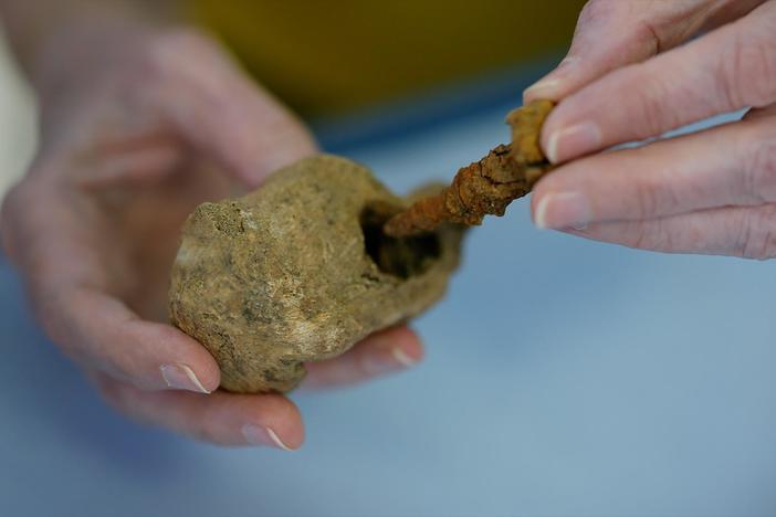An osteoarcheologist explores possible explanations for a nail found through a heel bone.