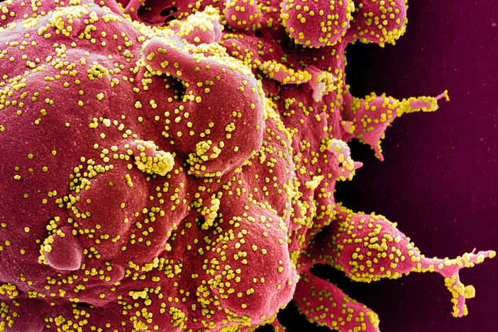 A colorized electron micrograph image of a cell (red) infected with with SARS-CoV-2 virus particles (yellow), isolated from a patient sample.