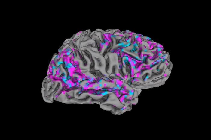 This video still shows a view of one person's cerebral cortex. Pink areas have above-average activity; blue areas have below-average activity.