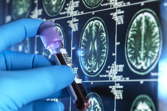 Newer blood tests can help doctors diagnose Alzheimer's disease without a brain scan or spinal tap. But some tests are more accurate than others.