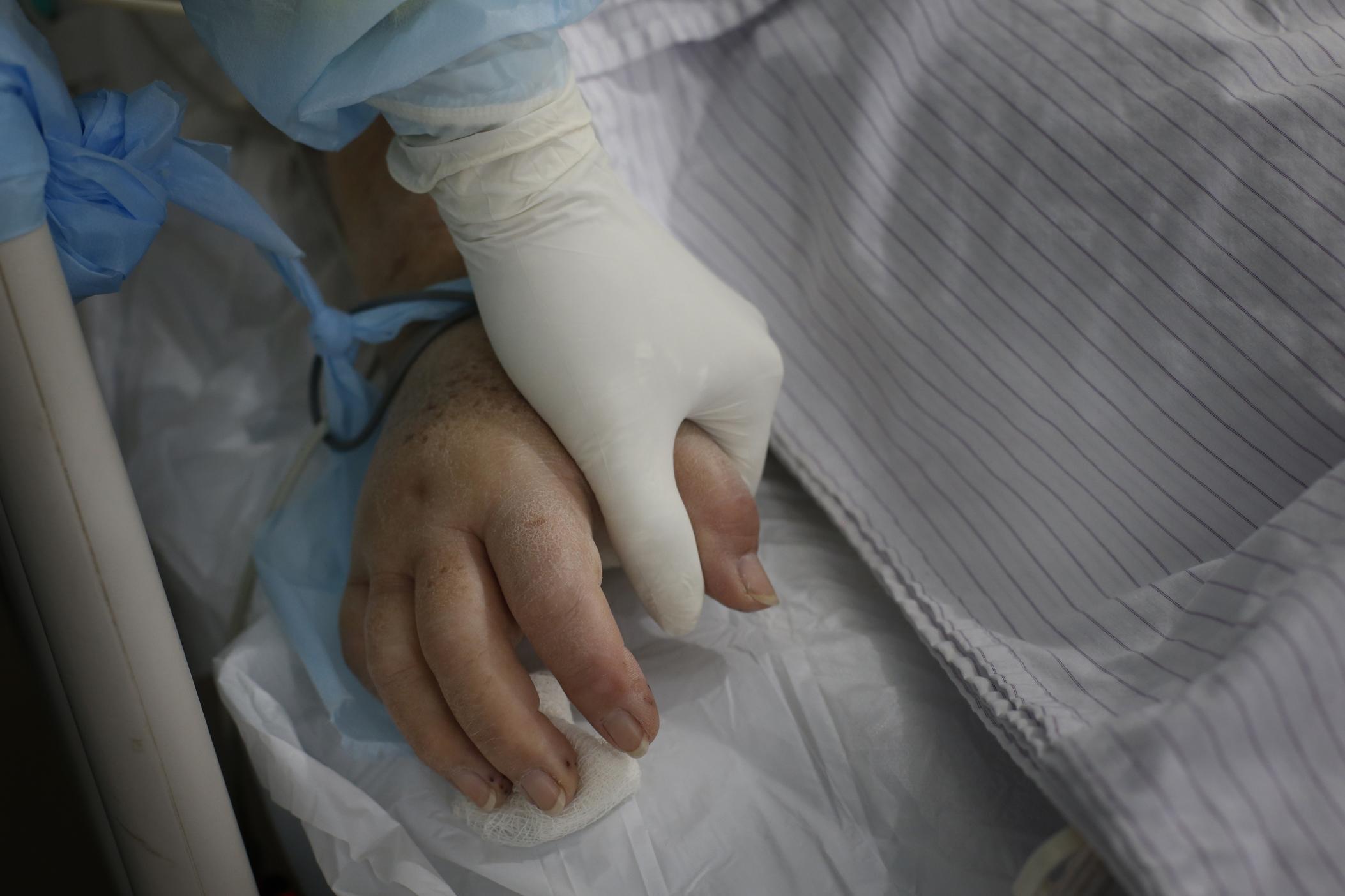 gloved hand holds swollen hand of person in ICU