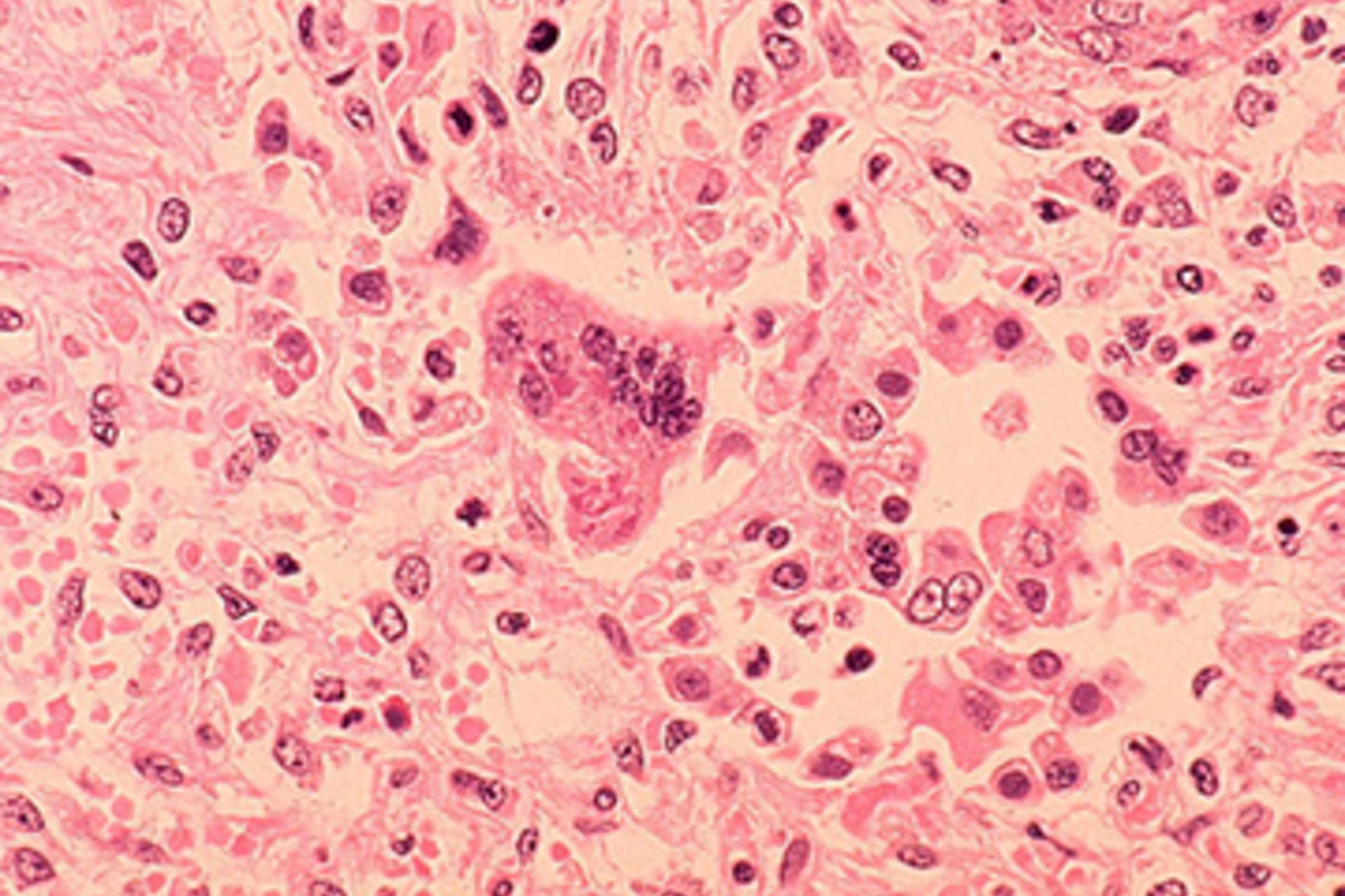 Measles 