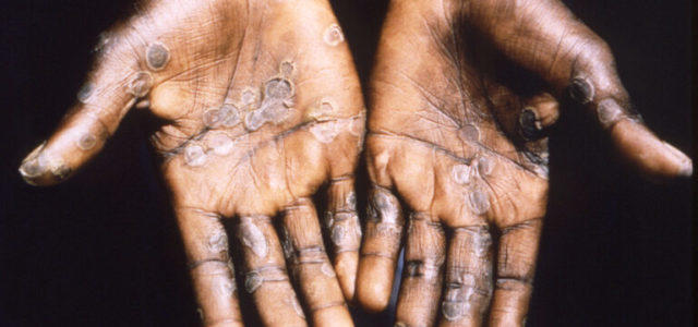 Photo of Monkey Pox