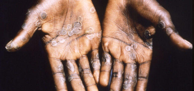 Photo of Monkeypox