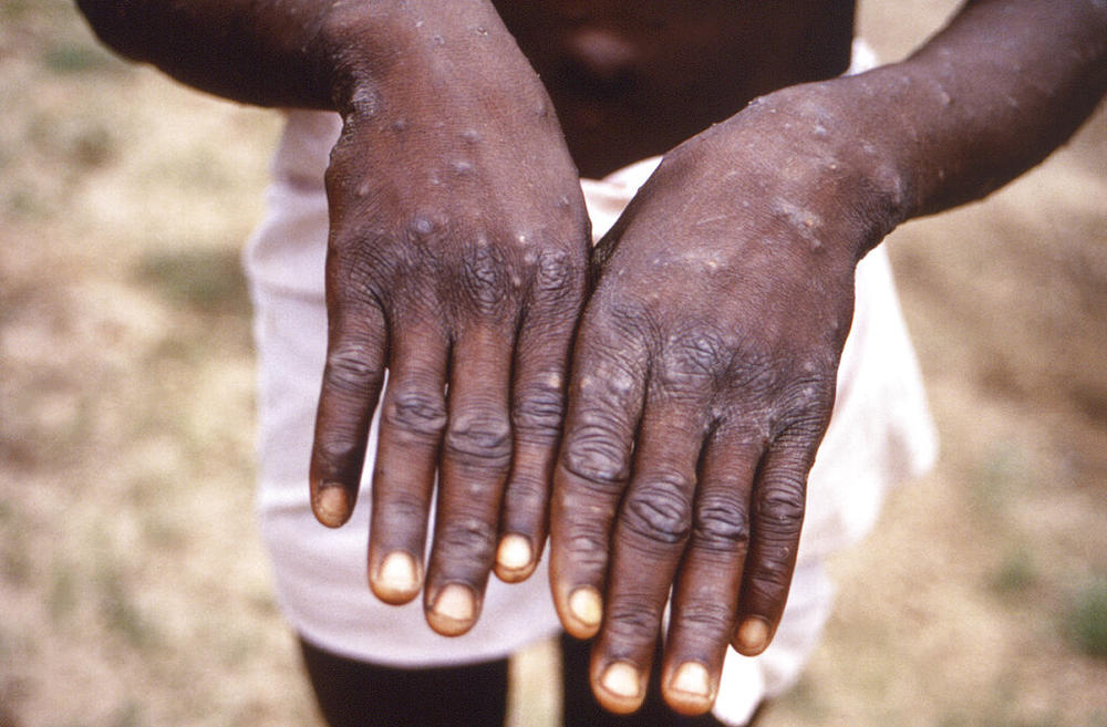 The dorsal surfaces of the hands of a monkeypox case patient, who was displaying the appearance of the characteristic rash during its recuperative stage.