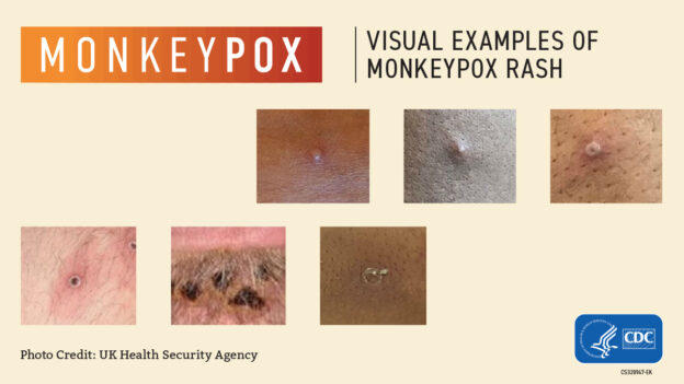 Examples of monkeypox rash on skin