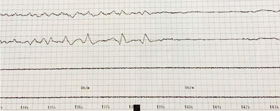 Brain activity from an unnamed ECT patient is recorded and printed out onto a chart for doctors to review. The induced seizure is represented by the spikes in the horizontal lines. (Special to The Macon Newsroom)
