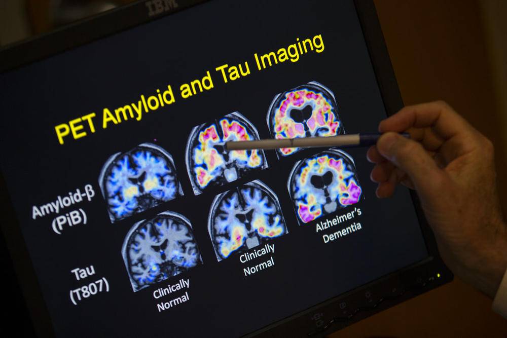 PET scan results that are part of a study on Alzheimer's disease at Georgetown University Hospital in Washington