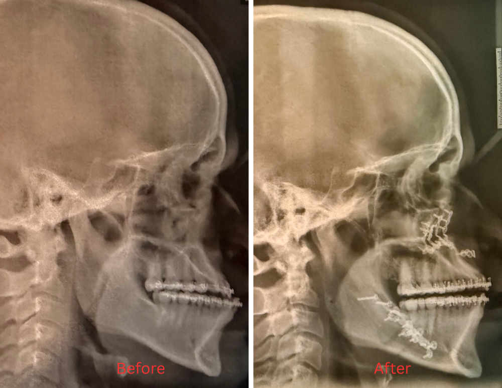 these are x-ray images of my jaw before and after my surgery.