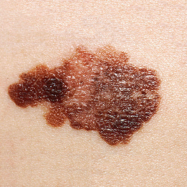 Melanoma, Courtesy, <a href="http://commons.wikimedia.org/wiki/File:Melanoma_(2).jpg" target="_blank"> Wikimedia</a>