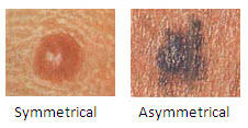Melanoma In Men a.jpg