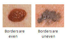 Melanoma In Men b.jpg