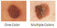 Melanoma In Men c.jpg