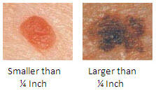 Melanoma In Men d.jpg