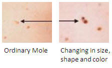 Melanoma In Men e.jpg