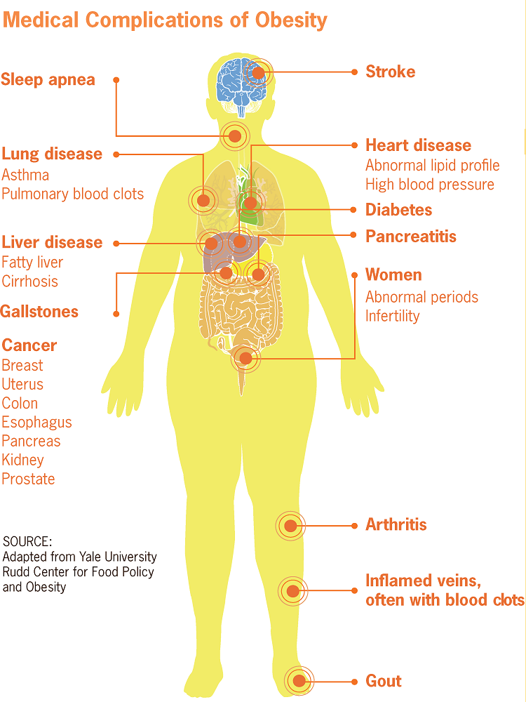 medical_complications_of_obesity_0.png