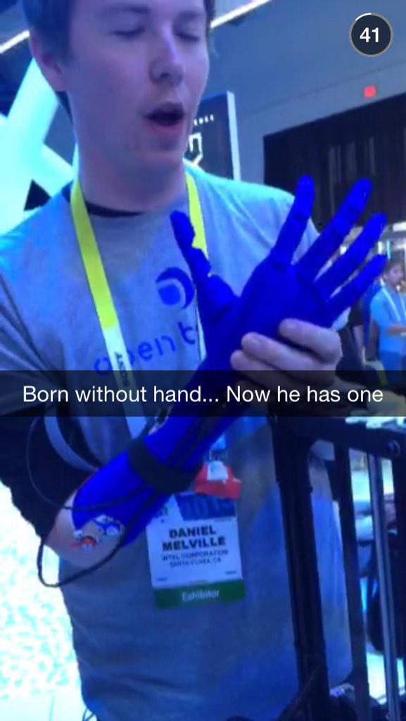 born-without-hand.jpg