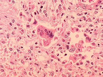 Measles 