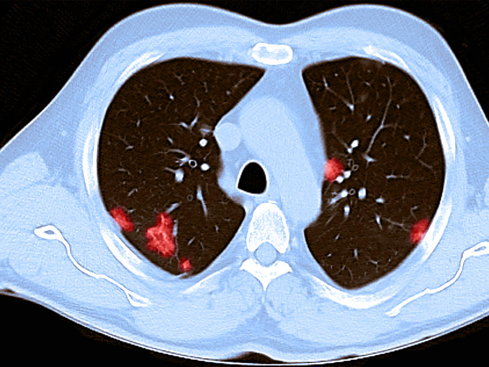 A CT scan of the chest of a 66-year-old male reveals patchy rounded hazy spots throughout the lungs. He had tested positive for the coronavirus and experienced shortness of breath.