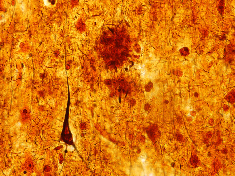 This light micrograph from the brain of someone who died with Alzheimer's disease shows the plaques and neurofibrillary tangles that are typical of the disease. A glitch that prevents healthy cell structures from transitioning from one phase to the next might contribute to the tangles, researchers say.