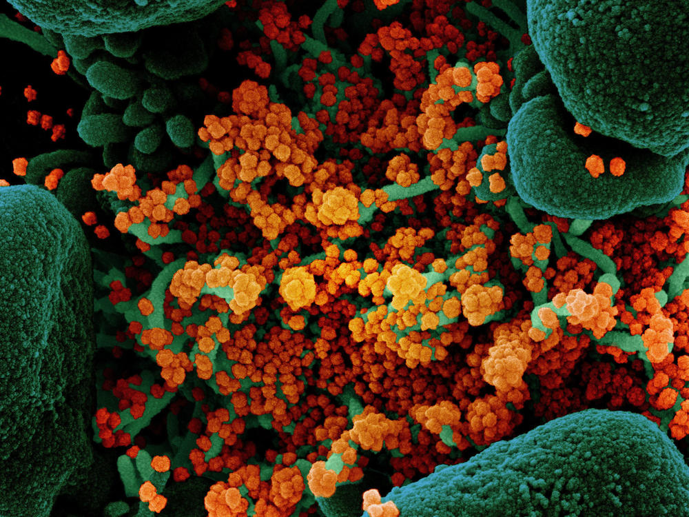 A colorized scanning electron micrograph of a cell (green) heavily infected with particles (orange) from the virus that causes COVID-19, isolated from a patient sample.