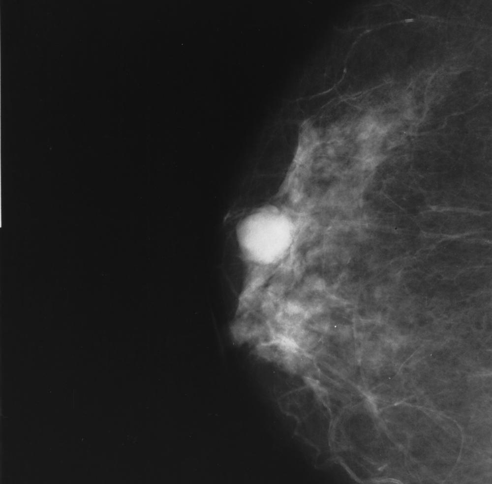 A mammogram of a breast with a whitish area diagnosed as colloid carcinoma.