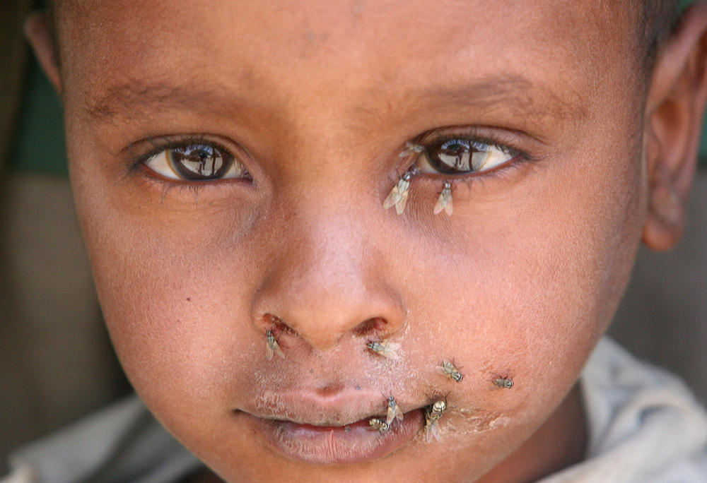 Trachoma, caused by a micro-organism, is highly contagious, spread by eye-seeking flies and through contact with the eye discharge of an infected person. Children and women are most susceptible to the infection.