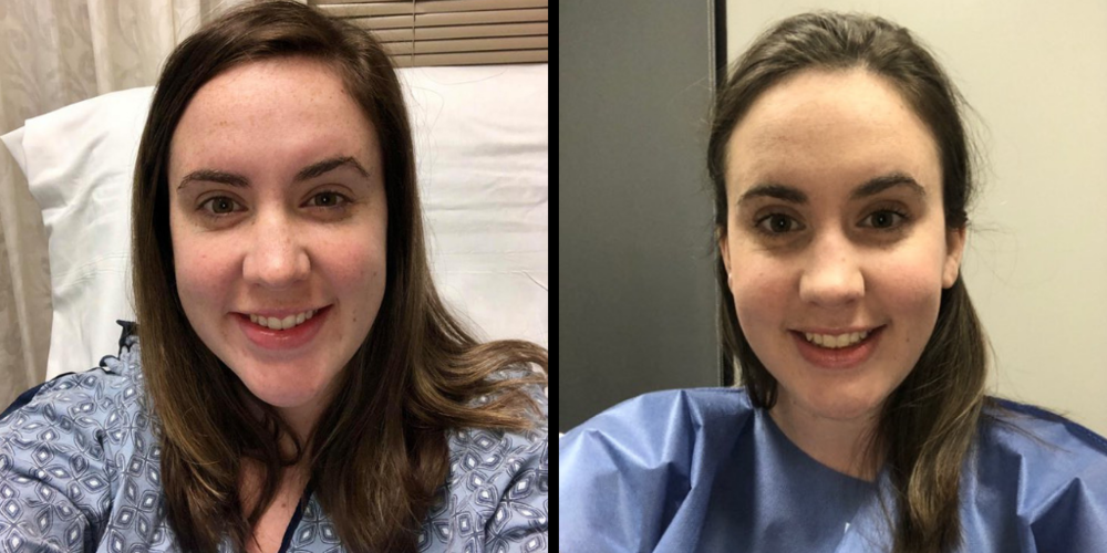 Lauren Caccavone before (left) and after surgery to remove her breast implant.