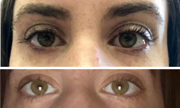 Lauren Caccavone took a picture of her eyes before and after her November 2018 surgery. She said she could see a dramatic reduction in dark circles under her eyes and pink inflammation in the sclera.
