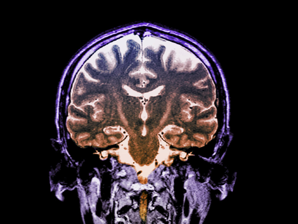 Patients with a fast-progressing form of ALS who got daily doses of an experimental two-drug combination called AMX0035 scored higher on a standard measure of function than patients who didn't get the drug.