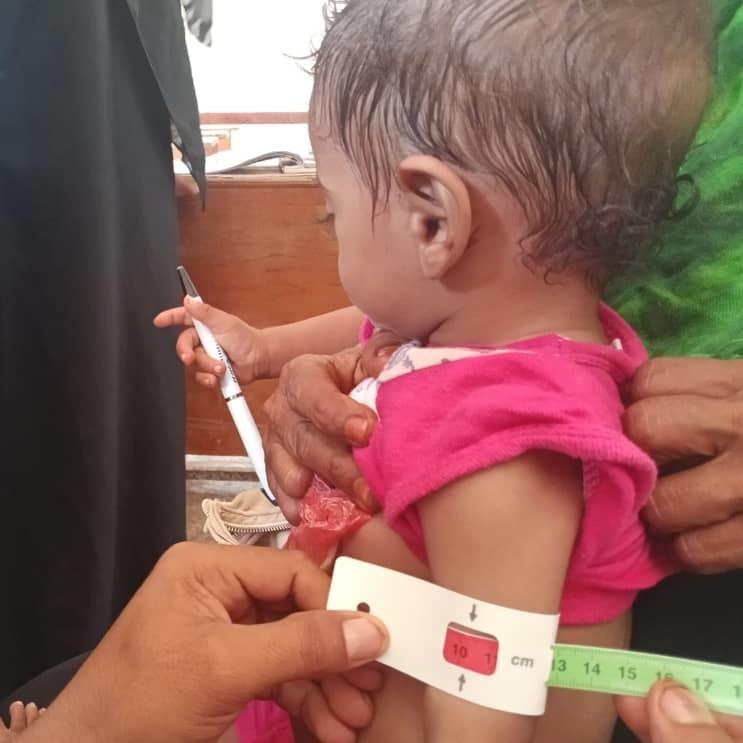 The circumference of an 18-month-old girl's arm is measured at nearly 4 inches, indicating severe acute malnutrition, at an International Medical Corps' outpatient nutrition clinic in Al Mukha, Taiz governate, Yemen. The measuring device is called a MUAC tape (middle upper arm circumference).