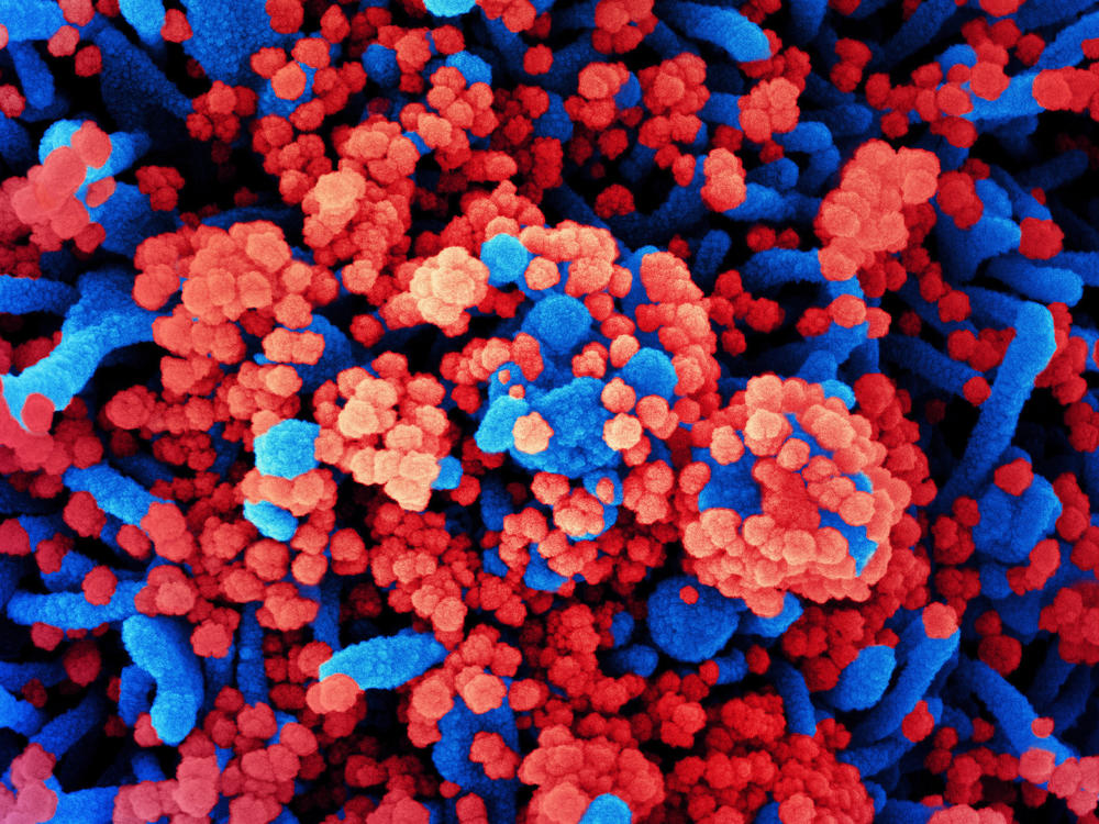 SARS-CoV-2 virus particles, shown in red, have heavily infected a cell in this colorized scanning electron micrograph. SARS-CoV-2 is the virus that causes COVID-19.