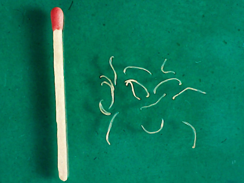 Adult hookworms from a dog. The larvae, which penetrate the skin, are even smaller.