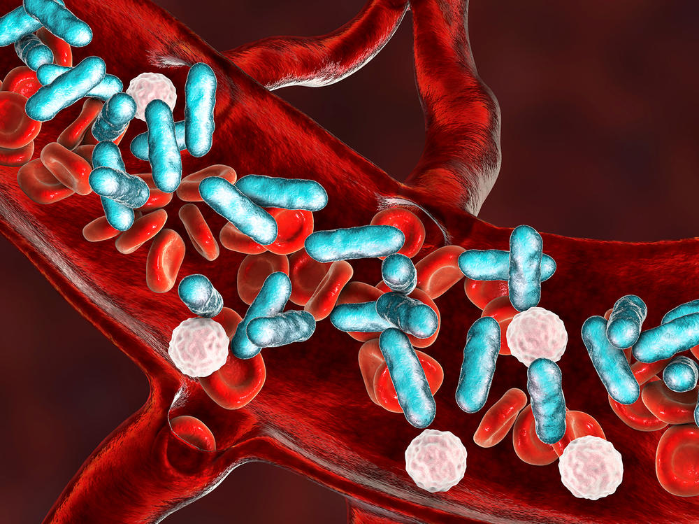 Sepsis, which is sometimes called blood poisoning, is essentially the body's overreaction to an infection.