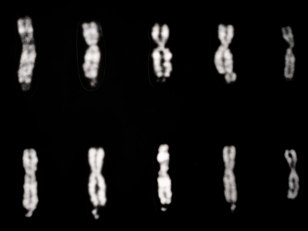 Fragile X syndrome involves changes in the X chromosome, as pictured in the four columns of chromosomes starting on the left. The fifth column, on the far right, shows two normal X chromosomes.