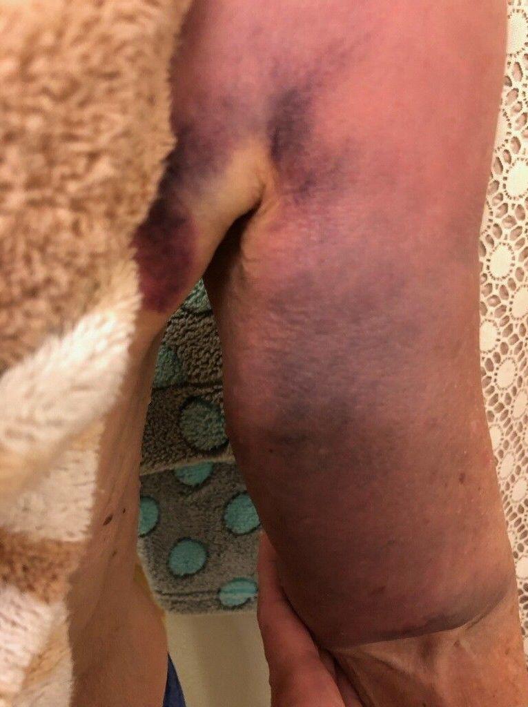 A close up photo of the back of Karen Garner's arm showing the injuries she allegedly sustained during the arrest on June 26, 2020.