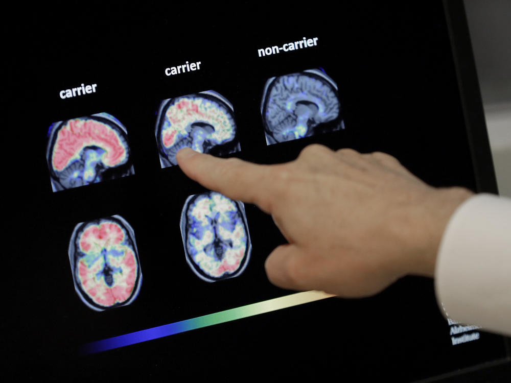 Dr. William Burke reviews a PET brain scan at Banner Alzheimer's Institute in Phoenix in 2018. An experimental Alzheimer's drug from Biogen and Eisai is on the verge of a Food and Drug Administration decision.