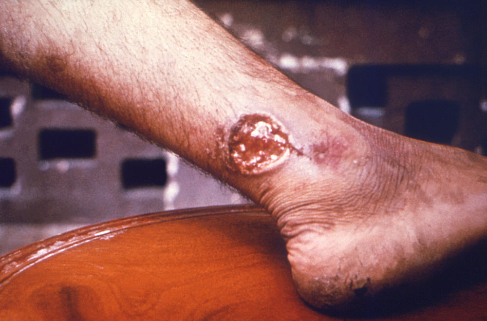 Some wounds caused by Leishmania parasites can lead to chronic skin ulcerations like this one if left untreated, specialists say. Still, it's important, they add, to tailor the treatment to the particular type of Leishmania — or risk making a mild problem worse.