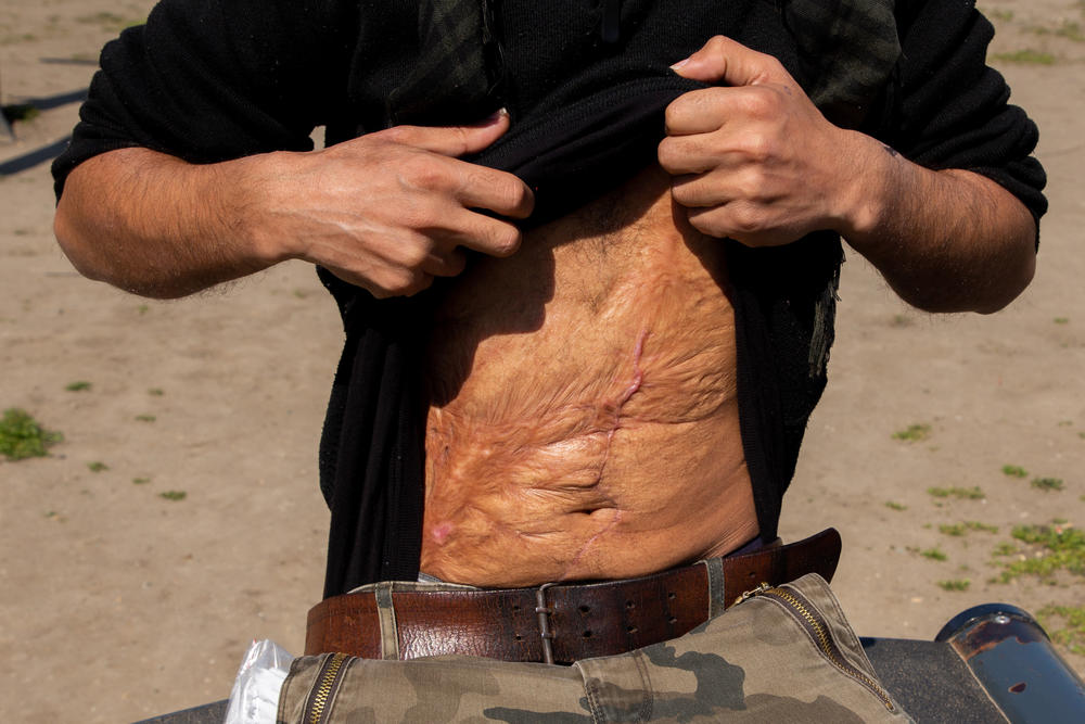 Hatem al-Hamad, 28, from Aleppo, Syria, and staying  in Serbia's Krnjaca asylum center, shows his scars. He says the main injury came from a bomb blast in the Syrian war. Additional scars are from surgery he underwent in Belgrade in February. He says Hungarian police assaulted him on the country's border with Croatia. Hungarian officials have denied allegations of abuse.