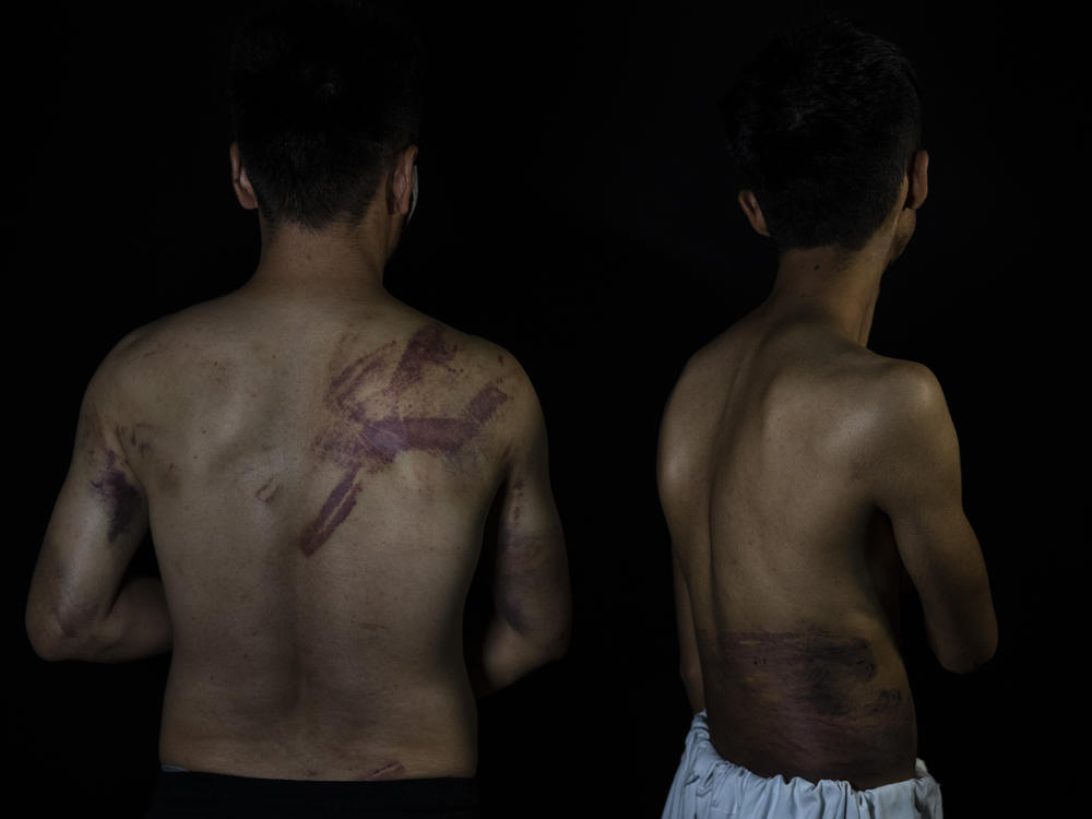 Afghan journalists Nematullah Naqdi, 28, and Taqi Daryabi, 22, show their injuries at the <em>Etilaatroz</em> office in Kabul, Sept. 10. Taliban forces detained and beat them after they covered a women's protest in Kabul.