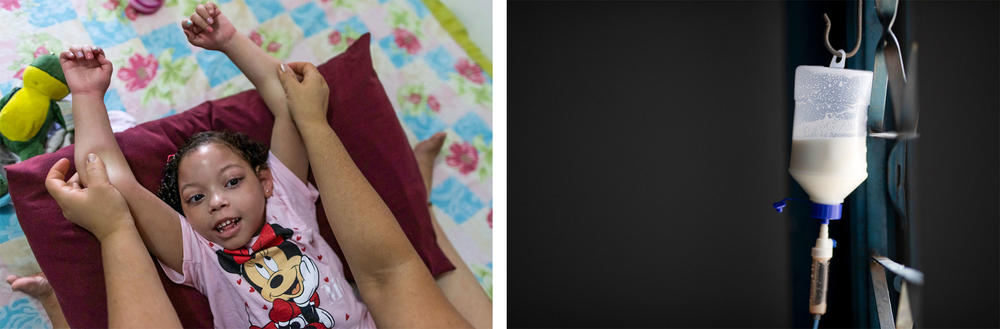 Left: Dos Santos helps her daughter, pictured, with physical therapy. Many children with congenital Zika disorder are physically disabled. Right: Due to difficulties swallowing, dos Santos' daughter uses a feeding tube, which is attached to her wheelchair.