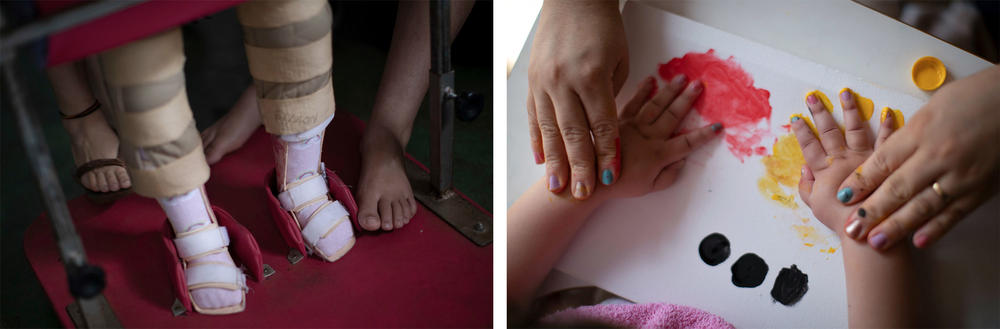Left: Dos Santos' daughter uses leg braces to help her stand. Other symptoms of the disorder emerge as children grow. Right: Dos Santos guides her daughter to create a finger painting. 