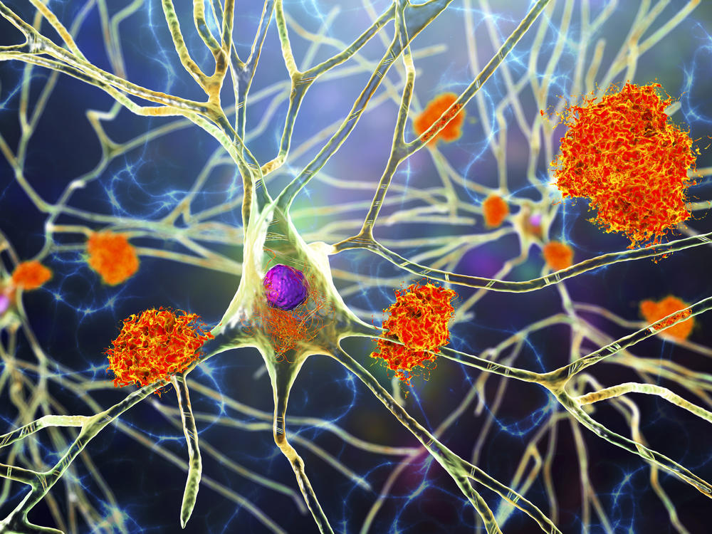 Amyloid plaques are characteristic features of Alzheimer's disease. The new drug Aduhelm is able to remove this sticky substance that builds up in the brains of patients with the disease, but many doctors are still skeptical of how well it really works.