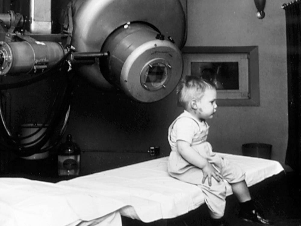 Gordon Isaacs, the first patient treated with the linear accelerator (radiation therapy) for retinoblastoma in 1957, sitting on a table. Gordon's right eye was removed January 11, 1957 because the cancer had spread. His left eye, however, had only a localized tumor that prompted Henry Kaplan to try to treat it with the electron beam. Gordon's vision in the left eye returned to normal.