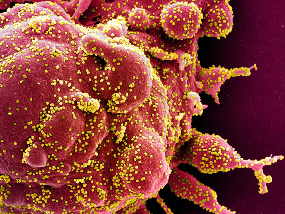 A colorized electron micrograph image of a cell (red) infected with with SARS-CoV-2 virus particles (yellow), isolated from a patient sample.