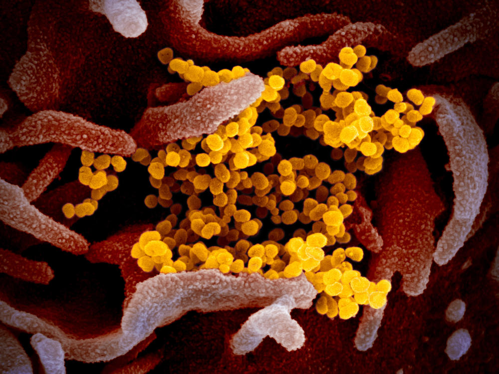 This colorized transmission electron micrograph image shows SARS-CoV-2, the coronavirus that causes the disease COVID-19. This specimen was isolated from a patient in the United States. Particles of the virus (yellow) are emerging from the surface of cells cultured in the lab (pink).