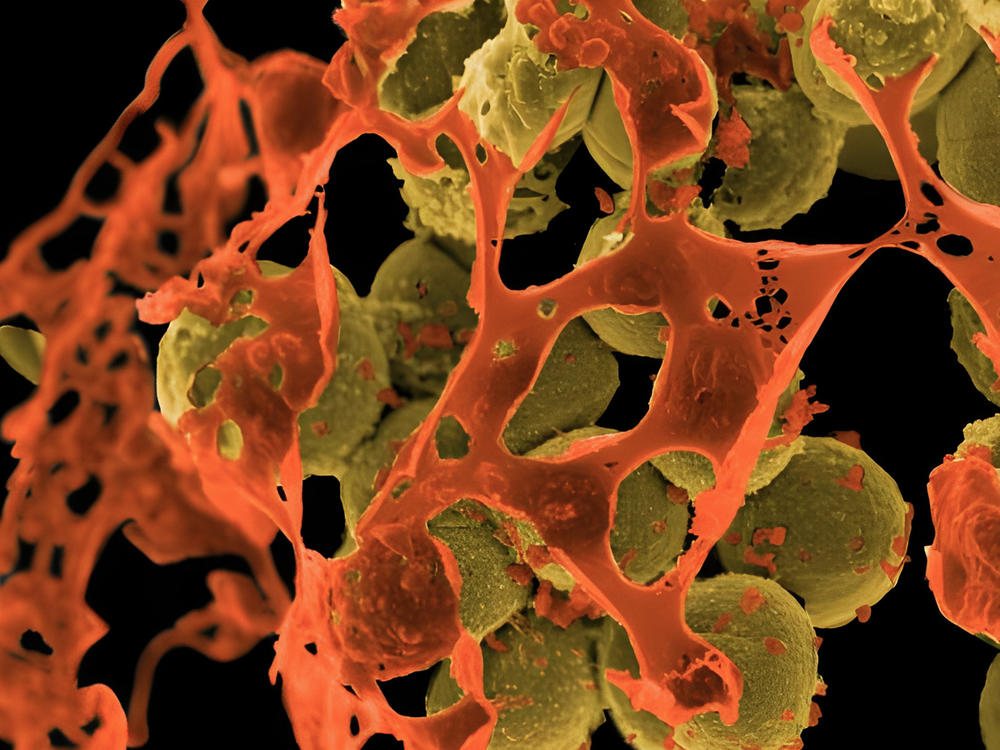 MRSA (methicillin-resistant <em>Staphylococcus aureus</em>), depicted above in yellow and surrounded by cellular debris, is a staph bacterium that resists treatment by many common antibiotics. The image is from a scanning electron micrograph.