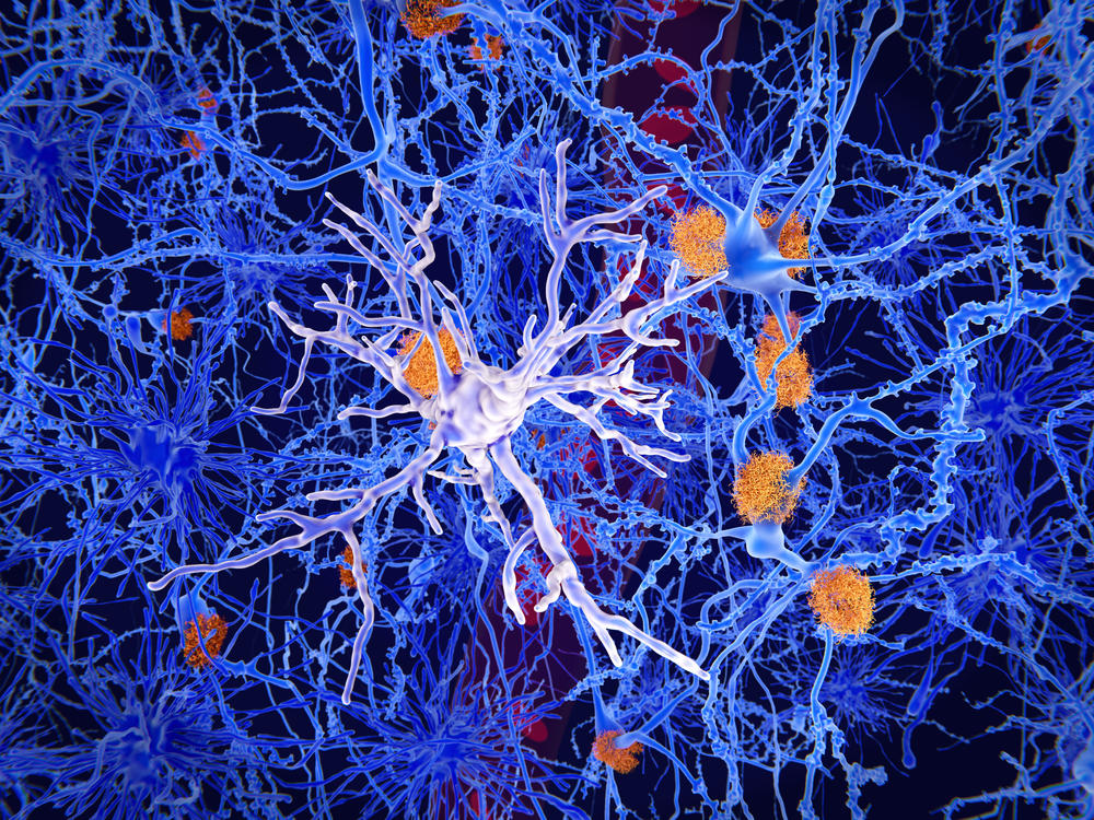 Microglia, specialized cells like the one seen in the center of this image, can restrain the accumulation of beta-amyloid protein (plaques in orange) that are a hallmark of Alzheimer's disease. But the cells sometimes contribute to the progression of the illness, researchers say.