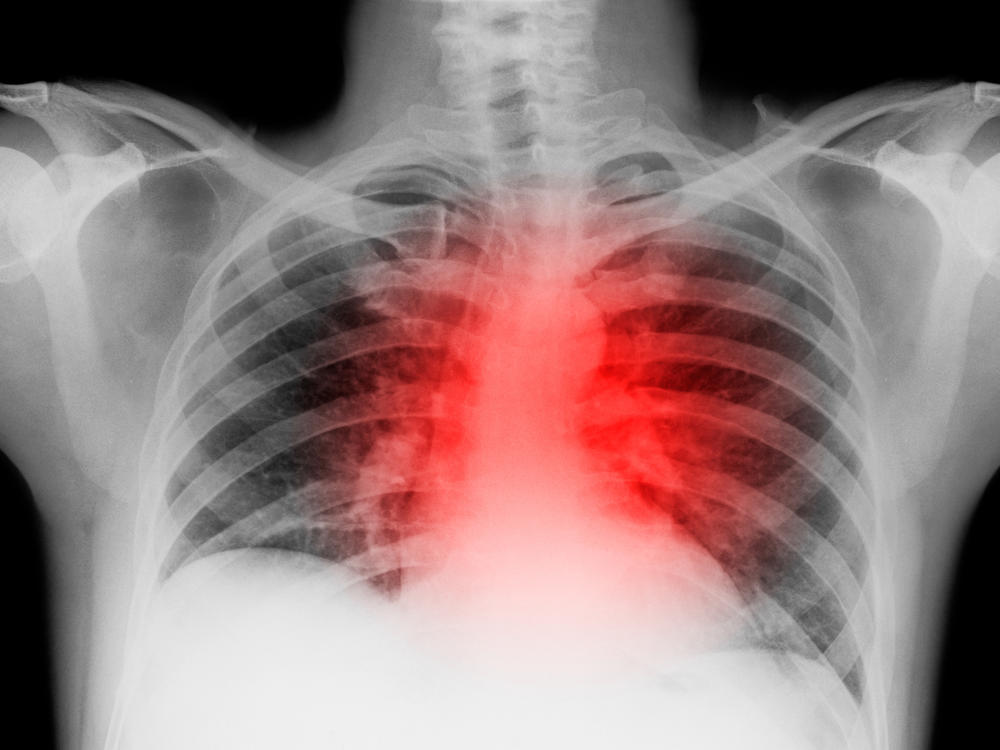 A large study found the incidence of cardiac and other serious cardiovascular problems was 4% higher in the 12 months after people were diagnosed with COVID-19 compared to those who were not infected.
